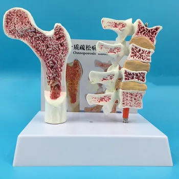 2 parti PVC Umane Anatomice Model Osteoporoza Femur Os de la Picior Spinării Secțiunea Specimen Bolnav coloanei Vertebrale Lombare
